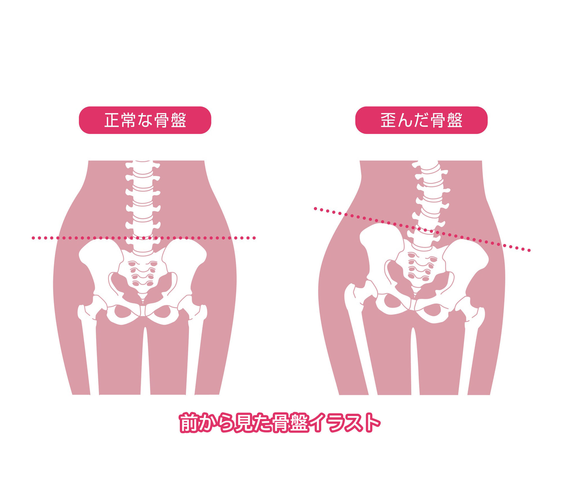 骨格はどの様にして歪むのか？ 骨格が歪むメカニズム