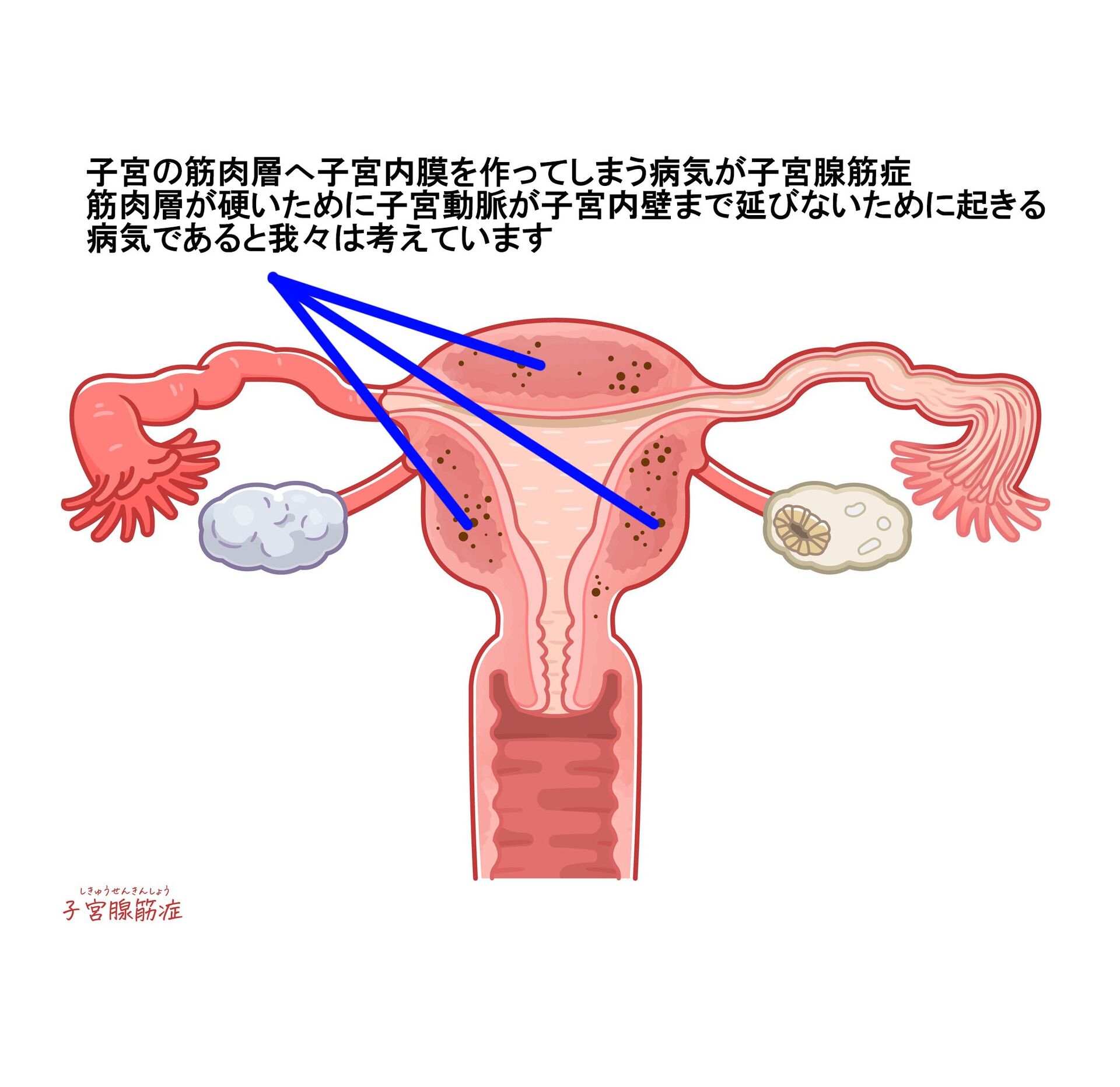 子宮腺筋症について